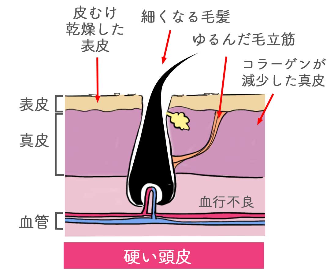 硬い頭皮